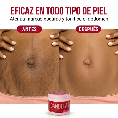 ZONA 2: ABDOMEN SIN ESTRÍAS